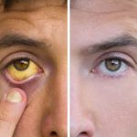 Bahaya Penyakit Kuning Pada Orang Dewasa Memahami Risiko Dan Pentingnya Penanganan Cepat