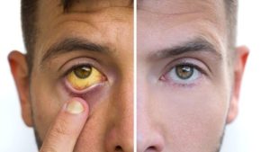 Bahaya Penyakit Kuning Pada Orang Dewasa Memahami Risiko Dan Pentingnya Penanganan Cepat