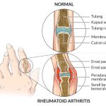 Cara Mengatasi Nyeri Sendi Akibat Rheumatoid Arthritis Secara Natural Pendekatan Holistik Untuk Meredakan Peradangan