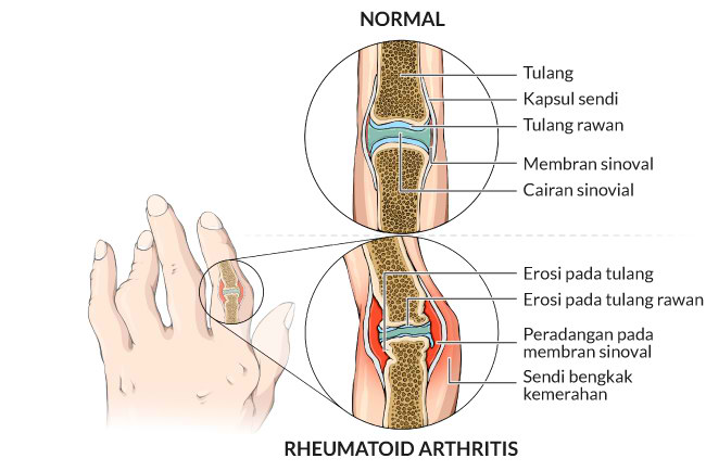 Cara Mengatasi Nyeri Sendi Akibat Rheumatoid Arthritis Secara Natural Pendekatan Holistik Untuk Meredakan Peradangan
