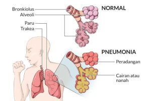 Gejala Infeksi Paru Paru Pneumonia Mengenali Tanda Tanda Awal Dan Pentingnya Penanganan Cepat