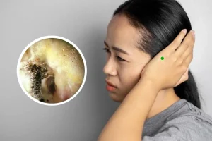 Bahaya Jamur Telinga Akibat Tws Penyebab Gejala Dan Cara Mencegahnya